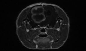 Rat Brain Tumor